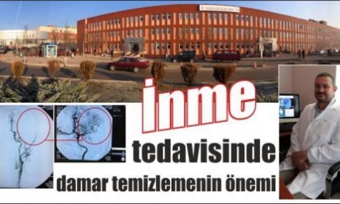 İnme Tedavisinde Damar Temizlemenin Önemi